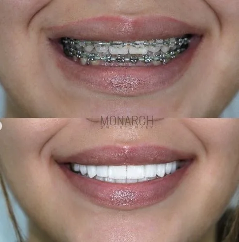 Emax-Empress Veneers Crowns and Veneers in Turkey